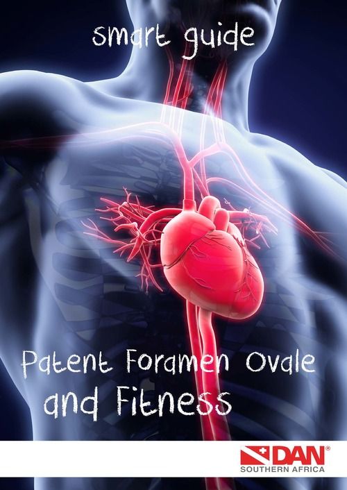 dan-smart-guide-patent-foramen-ovale-and-fitness